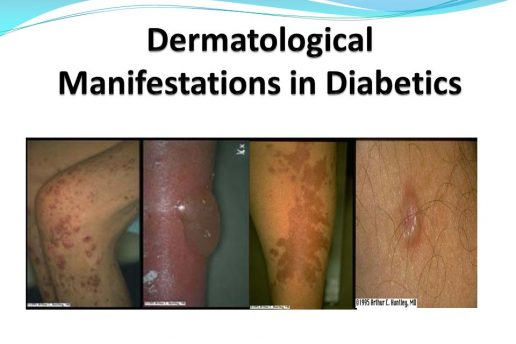 Dermatological diseases at diabetes mellitus